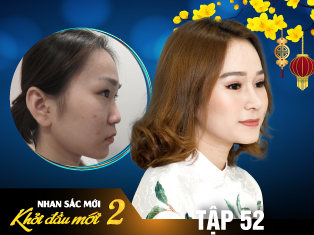 Tập 52: 9X Việt Kiều Đẹp Tựa Thiên Thần Sau Khi Nâng Mũi