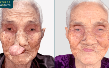 Cụ bà 100 tuổi được hồi sinh kỳ diệu sau 30 năm bị khối u bóp nghẹt hơi thở