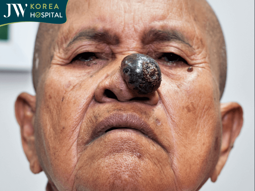 Khối u ác tính của sư bà khi đến JW