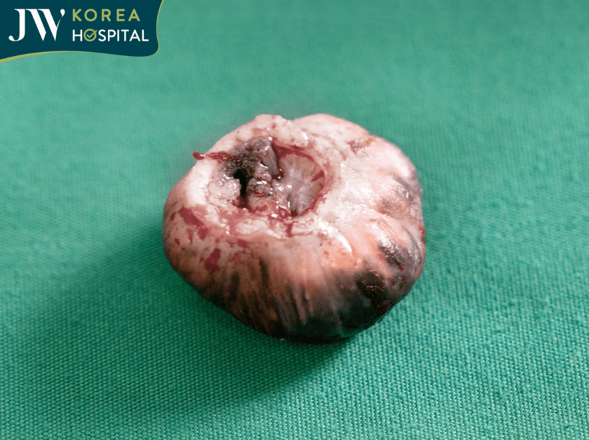 Khối U được lấy ra 