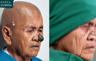 sư bà khơ-me cắt u mũi tại Bệnh viện JW