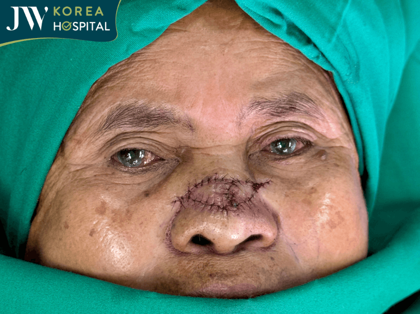 Sư bà lấy khối U thành công